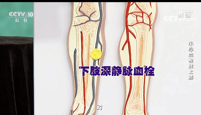 健康 > 正文    长时间站立工作或长时间翘二郎腿,都容易导致下肢静脉